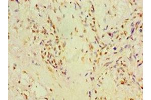 Immunohistochemistry of paraffin-embedded human breast cancer using ABIN7164785 at dilution of 1:100