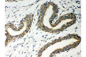 IHC-P: ERAB antibody testing of human breast cancer tissue (HSD17B10 抗体  (AA 48-261))