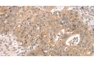 Immunohistochemistry of paraffin-embedded Human breast cancer using STX10 Polyclonal Antibody at dilution of 1:45 (Syntaxin 10 抗体)