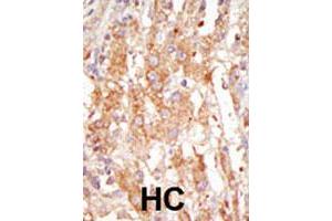 Formalin-fixed and paraffin-embedded human hepatocellular carcinoma tissue reacted with the MAP3K6 polyclonal antibody  , which was peroxidase-conjugated to the secondary antibody, followed by DAB staining. (MAP3K6 抗体  (C-Term))