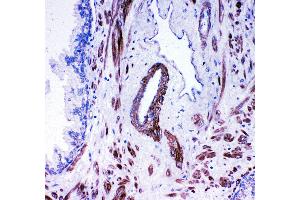 Anti- ACE antibody,  IHC(P) IHC(P): Human Prostatic Cancer Tissue (Angiotensin I Converting Enzyme 1 抗体  (Middle Region))