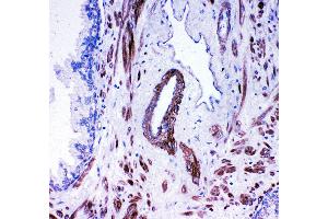 Anti- ACE antibody,  IHC(P) IHC(P): Human Prostatic Cancer Tissue