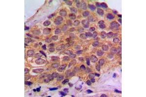 Immunohistochemical analysis of S6K1 (pS434) staining in human breast cancer formalin fixed paraffin embedded tissue section.