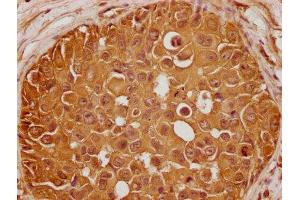 IHC image of ABIN7140243 diluted at 1:100 and staining in paraffin-embedded human breast cancer performed on a Leica BondTM system. (GLI2 抗体  (AA 2-20))
