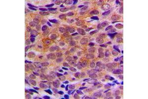Immunohistochemical analysis of ARFIP1 staining in human breast cancer formalin fixed paraffin embedded tissue section. (ARFIP1 抗体  (C-Term))