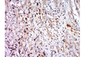 Paraformaldehyde-fixed, paraffin embedded human cervical cancer, Antigen retrieval by boiling in sodium citrate buffer (pH6) for 15min, Block endogenous peroxidase by 3% hydrogen peroxide for 30 minutes, Blocking buffer (normal goat serum) at 37°C for 20min, Antibody incubation with MFAP1 Polyclonal Antibody, Unconjugated  at 1:500 overnight at 4°C, followed by a conjugated secondary and DAB staining (MFAP1 抗体  (AA 31-120))