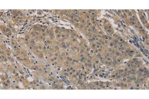 Immunohistochemistry of paraffin-embedded Human gastric cancer tissue using AGTRAP Polyclonal Antibody at dilution 1:40 (AGTRAP 抗体)