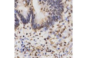Immunohistochemistry of paraffin-embedded human rectal cancer tissue using H3K27me3 antibody at dilution of 1:200 (x400 lens). (Histone 3 抗体  (H3K27me))