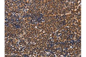 The image on the left is immunohistochemistry of paraffin-embedded Human lymphoma tissue using ABIN7128260(ADH1A Antibody) at dilution 1/20, on the right is treated with fusion protein. (ADH1A 抗体)