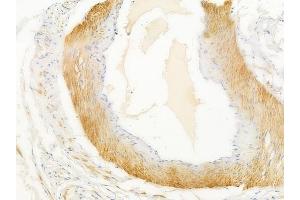 ABIN6259746 and ABIN6268898 at 1/100 staining human testicular cancer by IHC-P. (ACTG2 抗体  (N-Term))