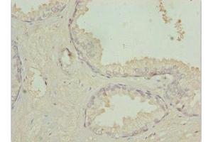 Immunohistochemistry of paraffin-embedded human prostate cancer using ABIN7172947 at dilution of 1:100 (TM9SF1 抗体  (AA 28-230))