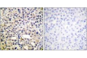 Immunohistochemistry analysis of paraffin-embedded human breast carcinoma, using Vimentin (Phospho-Ser56) Antibody. (Vimentin 抗体  (pSer56))