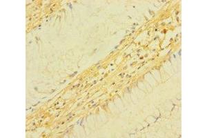 Immunohistochemistry of paraffin-embedded human colon cancer using ABIN7172934 at dilution of 1:100 (TM4SF5 抗体  (AA 112-157))