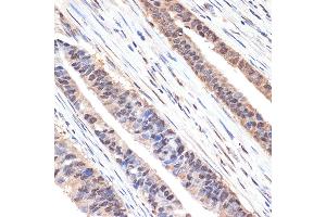Immunohistochemistry of paraffin-embedded human colon carcinoma using sestrin 1 Rabbit mAb (ABIN7270259) at dilution of 1:100 (40x lens). (SESN1 抗体)
