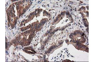 Immunohistochemical staining of paraffin-embedded Adenocarcinoma of Human colon tissue using anti-DSTN mouse monoclonal antibody. (Destrin 抗体)