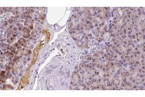 ABIN6273270 at 1/100 staining Human pancreas cancer tissue by IHC-P. (MYH6 抗体  (Internal Region))