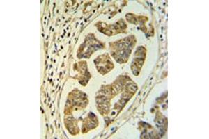Immunohistochemistry analysis in formalin fixed and paraffin embedded colon carcinoma reacted with HCCS / CCHL Antibody (Center) followed which was peroxidase conjugated to the secondary antibody and followed by DAB staining. (HCCS 抗体  (Middle Region))