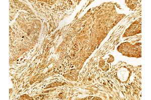 ABIN6263306 and ABIN6266597 at 1/100 staining Human lung cancer by IHC-P. (MMP7 抗体  (C-Term))