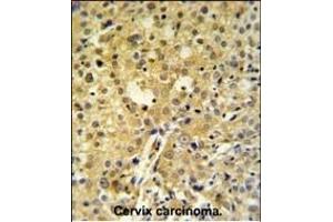 C2orf49 Antibody (N-term) (ABIN651382 and ABIN2840213) IHC analysis in formalin fixed and paraffin embedded human cervix carcinoma followed by peroxidase conjugation of the secondary antibody and DAB staining. (C2orf49 抗体  (N-Term))
