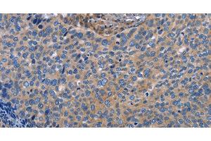 Immunohistochemistry of paraffin-embedded Human cervical cancer using INTS10 Polyclonal Antibody at dilution of 1:50 (INTS10 抗体)