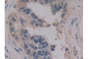 Detection of MPG1 in Human Breast cancer Tissue using Polyclonal Antibody to Macrophage Expressed Gene 1 Protein (MPG1) (MPEG1 抗体  (AA 313-580))