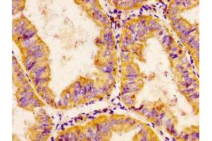 IHC image of ABIN7147653 diluted at 1:200 and staining in paraffin-embedded human endometrial cancer performed on a Leica BondTM system. (CHRDL1 抗体  (AA 92-237))