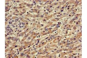 Immunohistochemistry of paraffin-embedded human liver cancer using ABIN7144881 at dilution of 1:100 (ABCA5 抗体  (AA 1230-1355))