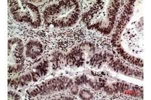 Immunohistochemistry (IHC) analysis of paraffin-embedded Human Colon Cancer, antibody was diluted at 1:100. (p53 抗体  (Internal Region))