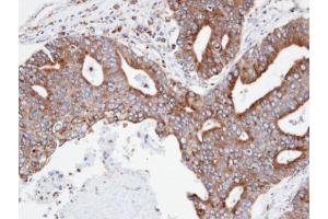 IHC-P Image Immunohistochemical analysis of paraffin-embedded human endo mitral ovarian cancer, using CPNE3, antibody at 1:100 dilution. (Copine III 抗体)