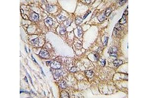 IHC analysis of FFPE human lung carcinoma tissue stained with Ihh antibody (Indian Hedgehog 抗体  (AA 1-30))