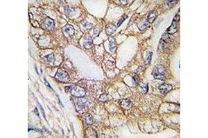 IHC analysis of FFPE human lung carcinoma tissue stained with Ihh antibody (Indian Hedgehog 抗体  (AA 1-30))
