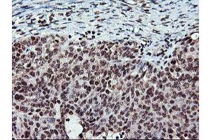 Immunohistochemical staining of paraffin-embedded Adenocarcinoma of Human ovary tissue using anti-TPSG1 mouse monoclonal antibody. (TPSG1 抗体  (AA 20-283))