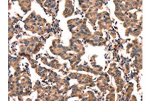 The image on the left is immunohistochemistry of paraffin-embedded Human breast cancer tissue using ABIN7128927(CGA Antibody) at dilution 1/65, on the right is treated with fusion protein. (CGA 抗体)