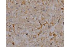 Immunohistochemical staining of human liver cancer tissue section with CAPZA1 monoclonal antibody, clone 2  at 1:100 dilution. (CAPZA1 抗体)