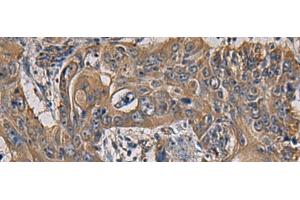 Immunohistochemistry of paraffin-embedded Human esophagus cancer tissue using CCNI Polyclonal Antibody at dilution of 1:65(x200) (Cyclin I 抗体)