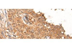 Immunohistochemistry of paraffin-embedded Human ovarian cancer tissue using NRG2 Polyclonal Antibody at dilution of 1:65(x200) (Neuregulin 2 抗体)