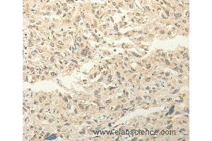 Immunohistochemistry of Human liver cancer using FZD8 Polyclonal Antibody at dilution of 1:50 (FZD8 抗体)