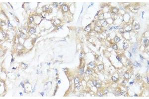 Immunohistochemistry of paraffin-embedded Human liver cancer using SMAD7 Polyclonal Antibody at dilution of 1:100 (40x lens). (SMAD7 抗体)