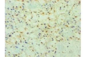 Immunohistochemistry of paraffin-embedded human breast cancer using ABIN7165066 at dilution of 1:100 (PRMT2 抗体  (AA 1-300))