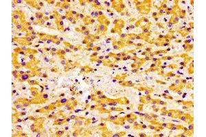 Immunohistochemistry of paraffin-embedded human liver cancer using ABIN7175433 at dilution of 1:100 (ACADVL 抗体  (AA 403-497))