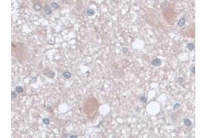 Detection of AST in Human Glioma Tissue using Monoclonal Antibody to Aspartate Aminotransferase (AST) (GOT1 抗体  (AA 1-413))