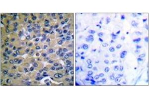 Immunohistochemistry analysis of paraffin-embedded human breast carcinoma, using IkappaB-epsilon (Phospho-Ser22) Antibody. (IkappaB-epsilon 抗体  (pSer22))
