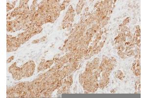 IHC-P Image Immunohistochemical analysis of paraffin-embedded human breast cancer, using Protease Inhibitor 15, antibody at 1:250 dilution. (PI15 抗体  (C-Term))
