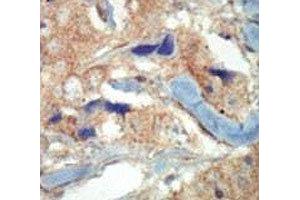 IHC analysis of FFPE human breast carcinoma tissue stained with the FLT3 antibody (FLT3 抗体  (AA 33-64))