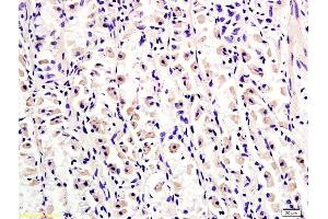 Formalin-fixed and paraffin embedded human gastric adenocarcinoma tissue labeled with Anti-Tuberin/TSC2 Polyclonal Antibody, Unconjugated (ABIN701200) at 1:300, followed by conjugation to the secondary antibody and DAB staining (Tuberin 抗体  (AA 1601-1750))