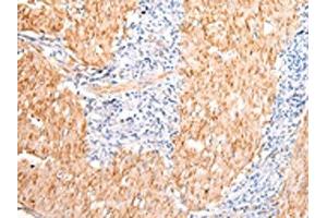 The image on the left is immunohistochemistry of paraffin-embedded Human gastric cancer tissue using ABIN7190483(DMBT1 Antibody) at dilution 1/20, on the right is treated with synthetic peptide. (DMBT1 抗体)