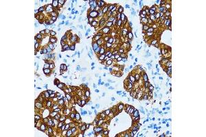 Immunohistochemistry of paraffin-embedded human gastric cancer using CTSE antibody (ABIN5971444) at dilution of 1/100 (40x lens). (Cathepsin E 抗体)