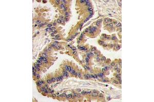Formalin-fixed and paraffin-embedded human lung carcinoma tissue reacted with Bmp6 antibody (N-term) (ABIN388456 and ABIN2848818) , which was peroxidase-conjugated to the secondary antibody, followed by DAB staining. (BMP6 抗体  (N-Term))