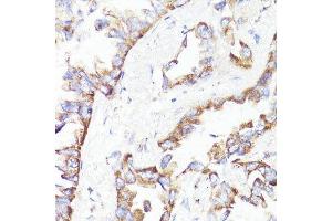 Immunohistochemistry (Paraffin-embedded Sections) (IHC (p)) image for anti-Receptor tyrosine-protein kinase erbB-2 (ErbB2/Her2) (C-Term) antibody (ABIN6140248)