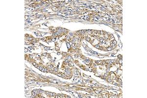 Immunohistochemistry of paraffin-embedded human lung cancer using S Rabbit mAb (ABIN7270501) at dilution of 1:250 (40x lens). (SAMM50 抗体)